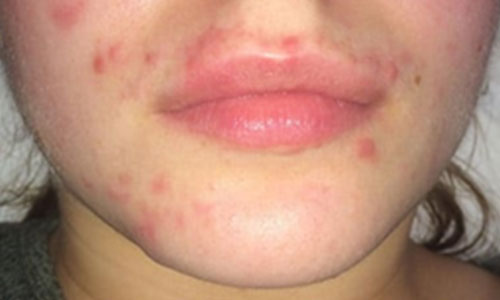 CLINICCARE Pure Complexion Clearing Facial Facial Treatment Glasgow