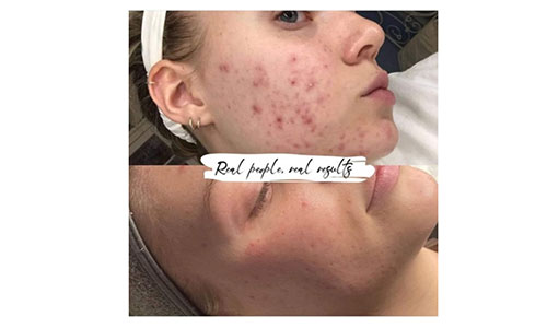 CLINICCARE Pure Chemical Peel Facial Treatment Glasgow